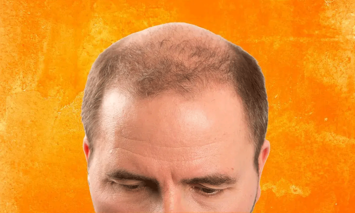 Eliminate Baldness In 20 Days