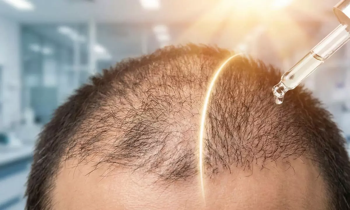 Brilliant News: Permanent Solution For Baldness Brilliant News: Permanent Solution For Baldness