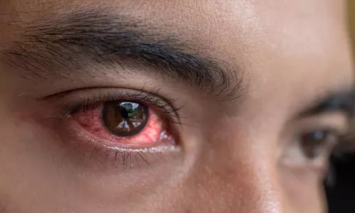 కళ్ల కలకలు స్టార్ట్... ఈ జాగ్రత్తలు తీసుకోండి!