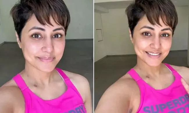 న‌టి శ‌రీరంపై కాలిన మ‌చ్చ‌లు.. కార‌ణం ఇదేనా?