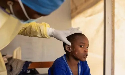 మన పక్క దేశానికీ వచ్చేసింది... మంకీ ఫాక్స్ ఎలా వ్యాపిస్తుందంటే..?