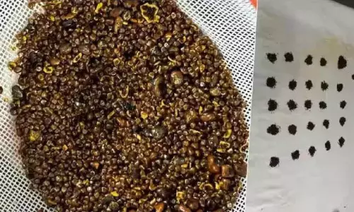 6,000 Stones Found in Man’s Stomach-Shocking Discovery!