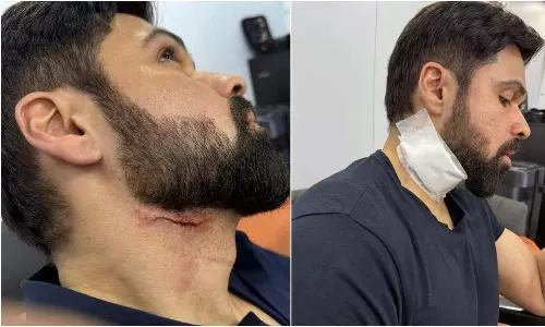 OG విల‌న్‌కి G2 సెట్లో మెడ‌కు గాయం