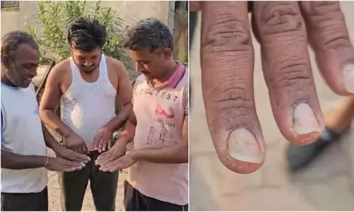 వింత వ్యాధి కలకలం.. జనాలకు ముందు జుట్టు ఆ తర్వాత ఊడిపోతున్న గోళ్లు!