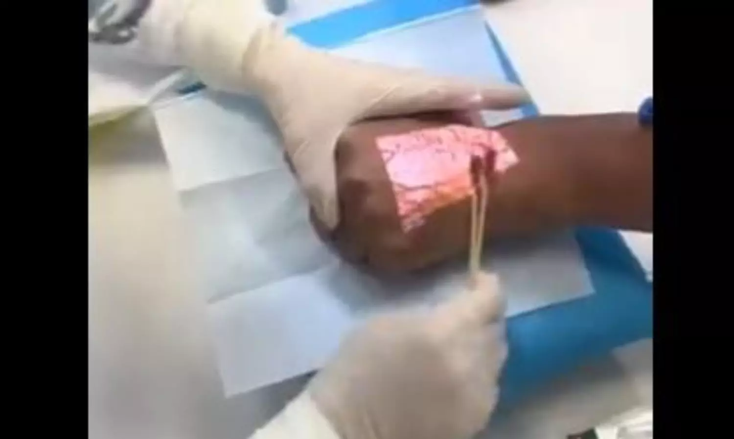 Vein Detection