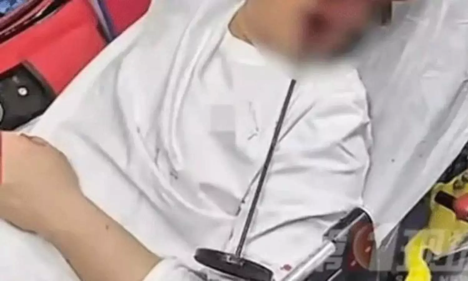 వీడికి భూమ్మీద నూకలున్నాయి..15ఇంచుల రాడ్ నోటి నుంచి దూసుకెళ్లినా బతికిండు