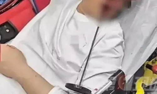 వీడికి భూమ్మీద నూకలున్నాయి..15ఇంచుల రాడ్ నోటి నుంచి దూసుకెళ్లినా బతికిండు