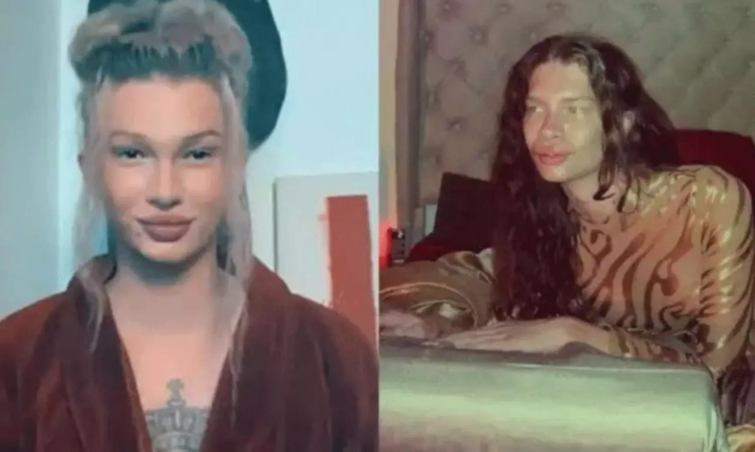 పిల్లిలా కనిపించాలని  కాస్మొటిక్  సర్జరీ... యువతి రిజల్ట్  ఇదే!