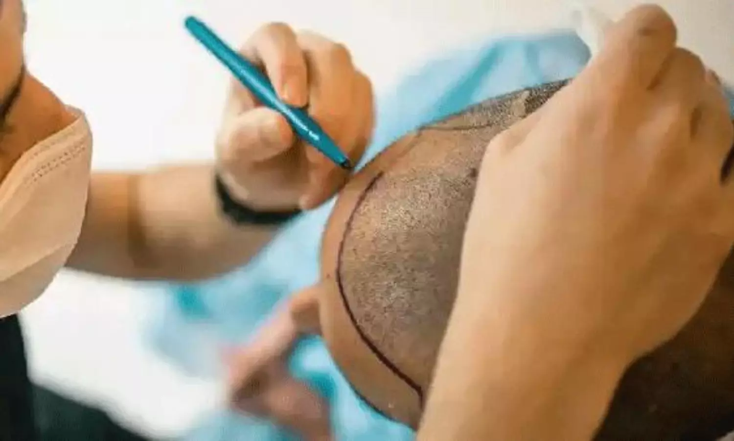 Hair Transplant Horror Two Engineers Die After Surgery Hair Transplant Horror Two Engineers Die After Surgery