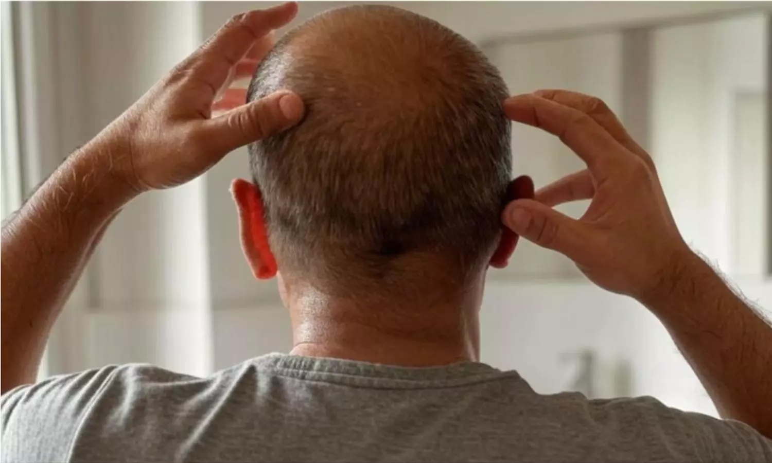 బట్టతల మీద జుట్టు.. సోషల్ మీడియాలో ప్రచారం.. పాతబస్తీలో వేలాదిగా క్యూ! బట్టతల మీద జుట్టు.. సోషల్ మీడియాలో ప్రచారం.. పాతబస్తీలో వేలాదిగా క్యూ!