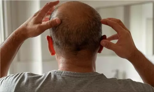 బట్టతల మీద జుట్టు.. సోషల్ మీడియాలో ప్రచారం.. పాతబస్తీలో వేలాదిగా క్యూ!