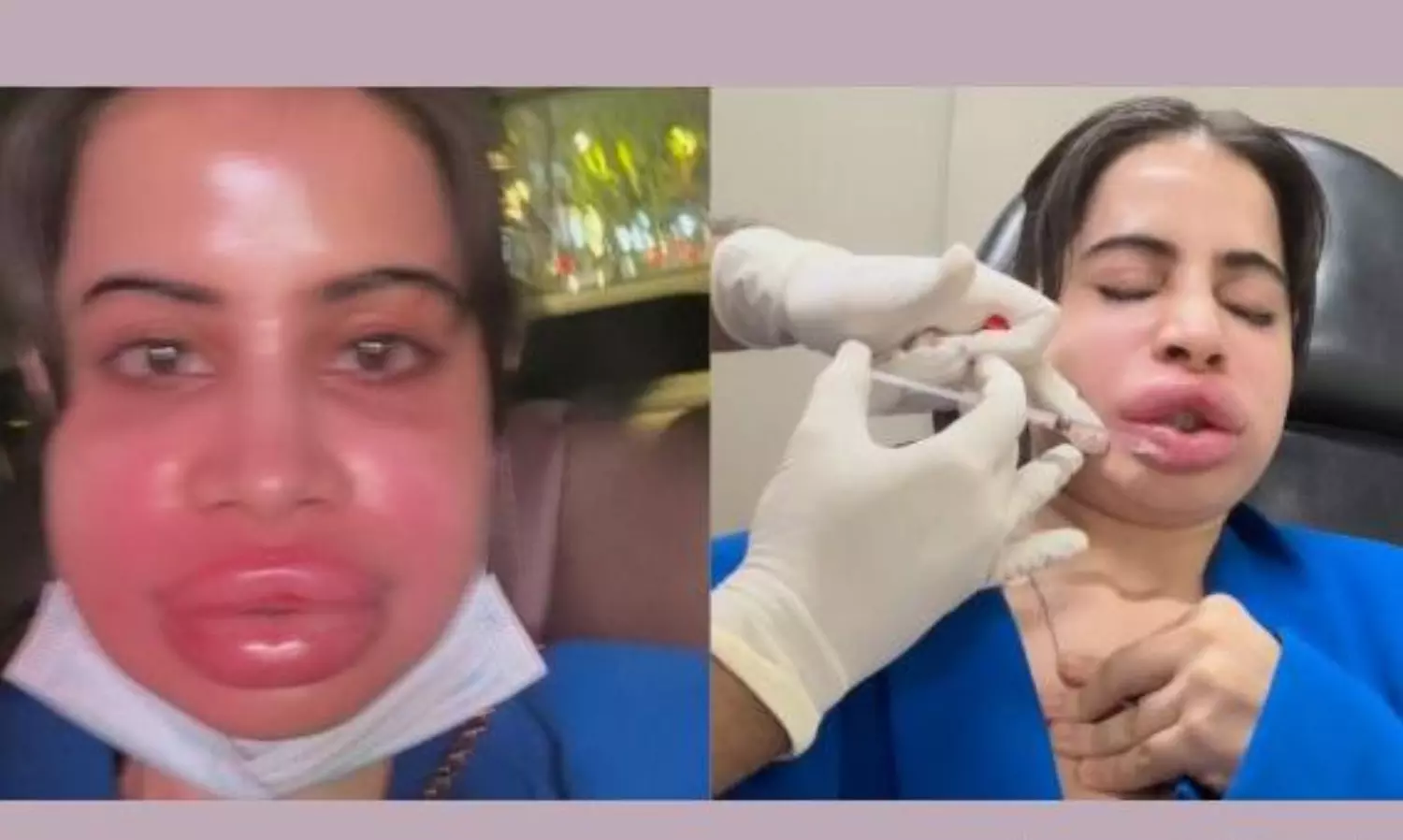 ఉబ్బిన పెద‌వులు వాచిన ముఖం.. ఊర్ఫీకి ఏమైంది?