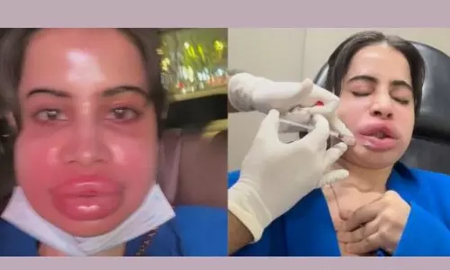 ఉబ్బిన పెద‌వులు వాచిన ముఖం.. ఊర్ఫీకి ఏమైంది?