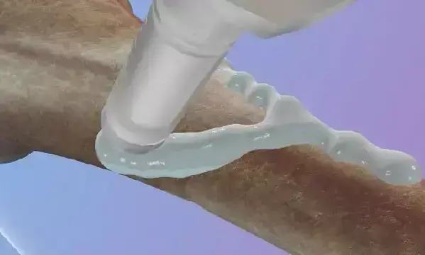 వస్తువులే కాదు విరిగిన ఎముకలు కూడా అతికించవచ్చు.. ఎలాగంటే?