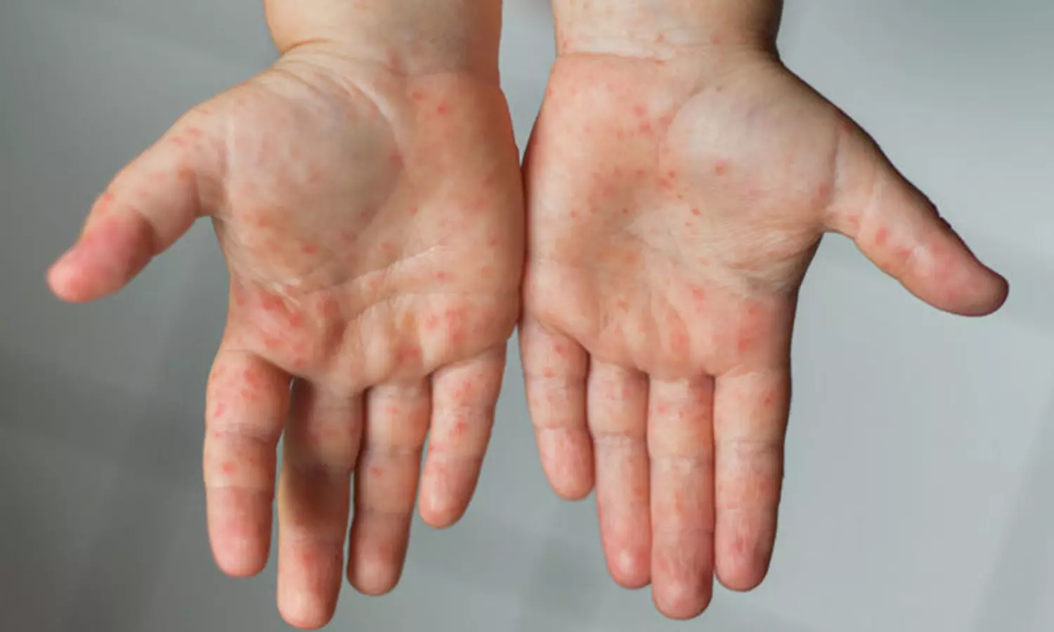 దేశంలో టమోటా వైరస్... పిల్లలు జాగ్రత్త.. స్కూల్స్ హెచ్చరికలు!