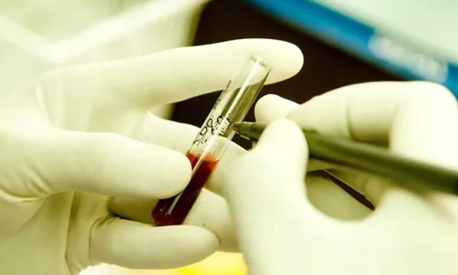 షాకింగ్... దేశంలో ఐదు మంది పిల్లలకు హెచ్.ఐ.వీ.  పాజిటివ్!