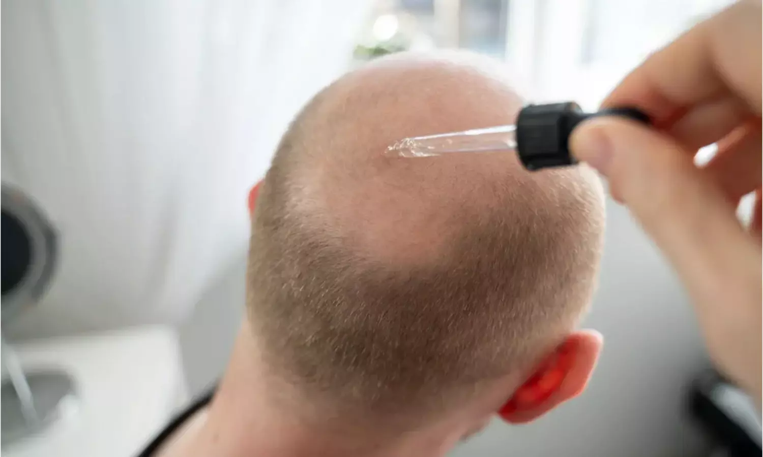 బట్టతలపై వెంట్రుకలు.. చైనా శాస్త్రవేత్తల అద్భుత సృష్టి..