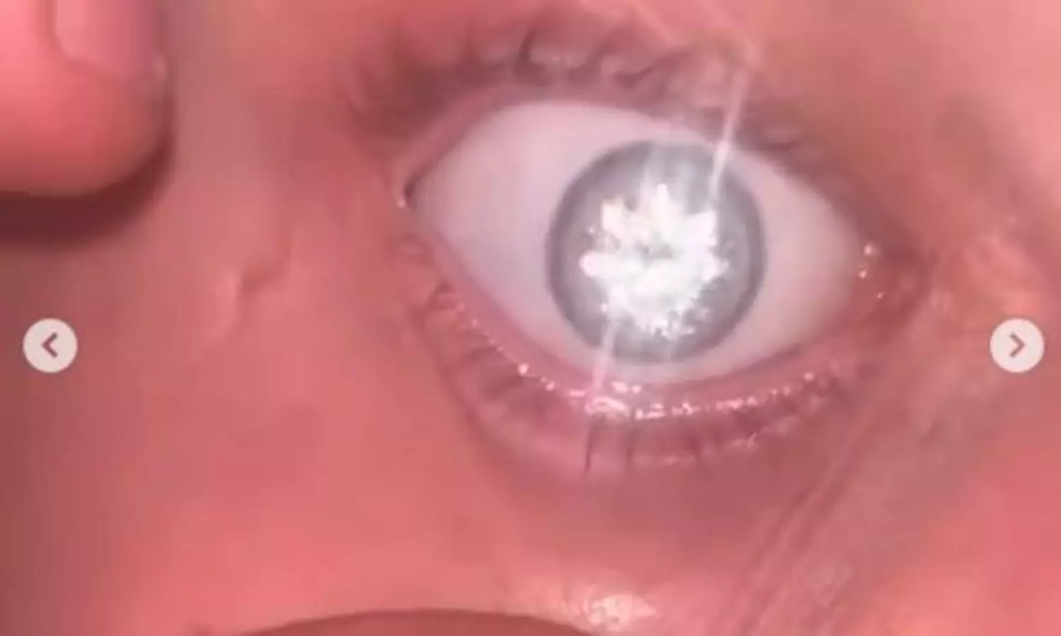 మెరుపులే మెరుపులు.. ఇతని కన్ను చూస్తే షాకవుతారు!