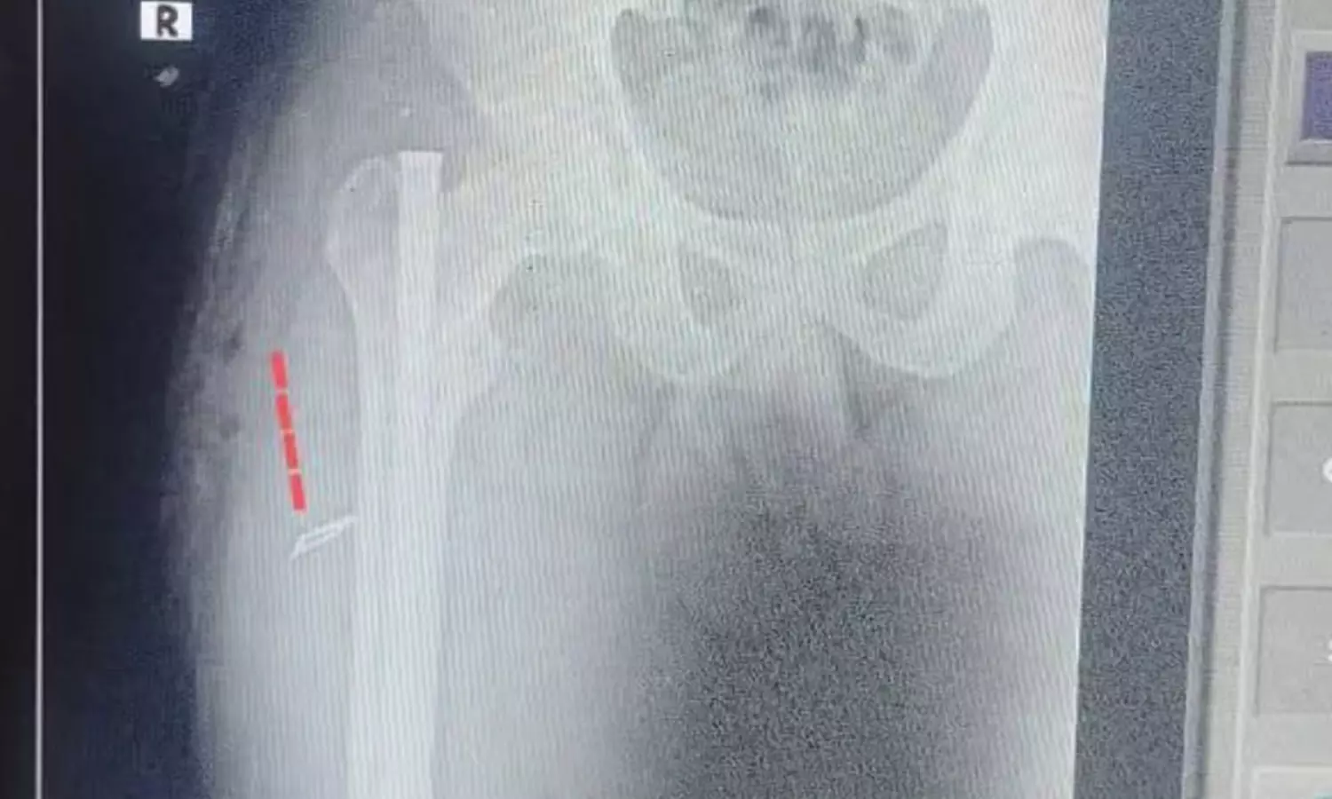 బ్లేడ్ ని కడుపులో పెట్టేసి కుట్టేసి...ఇదేంట్రా బాబూ...!