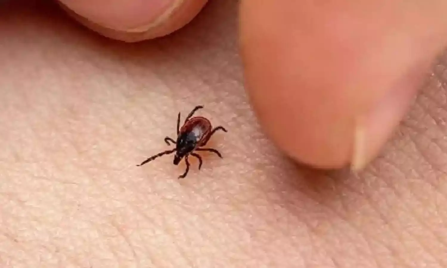 భయపెడుతున్న స్క్రబ్ టైఫస్...ప్రాణాంతకమా ? భయపెడుతున్న స్క్రబ్ టైఫస్...ప్రాణాంతకమా ?