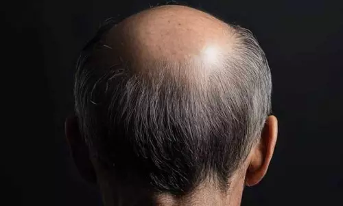 వైరల్  ఇష్యూ.. జాతీయ ఆరోగ్య బీమా పథకంలోకి బట్టతల సమస్య!