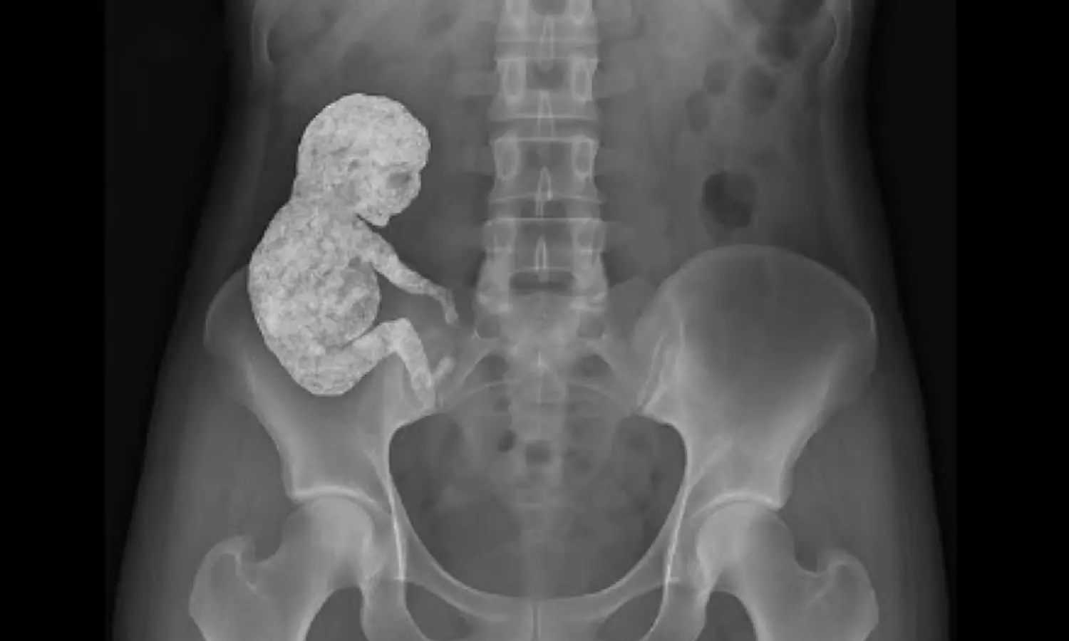 40 ఏళ్లుగా గర్భం మోసిన మహిళ..82 ఏళ్ల వయసులో నొప్పులు.. కట్ చేస్తే!