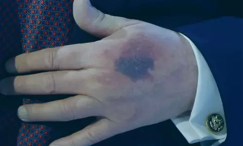 ట్రంప్‌ చేతిపై గాయం.. అధ్యక్షుడి ఆరోగ్యంపై మళ్లీ చర్చ