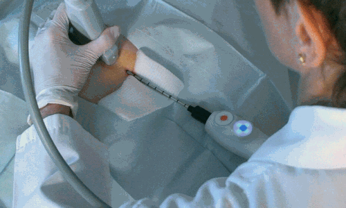 బ్రెస్ట్ క్యాన్సర్ కు మరింత మెరుగైన చికిత్స.. కోతలేకుండా ఒక్క రోజులోనే డిశ్చార్జ్..