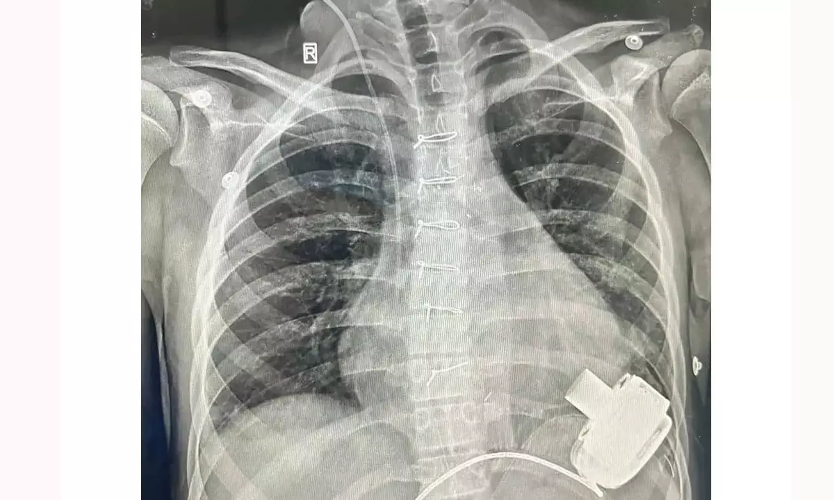 ఉజ్బెకిస్థాన్‌ బాలుడికి ప్రాణం పోసిన భారత వైద్యులు..