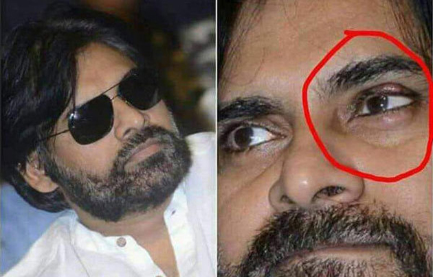 PKs Eye Surgery - Doctors Suggest REST!