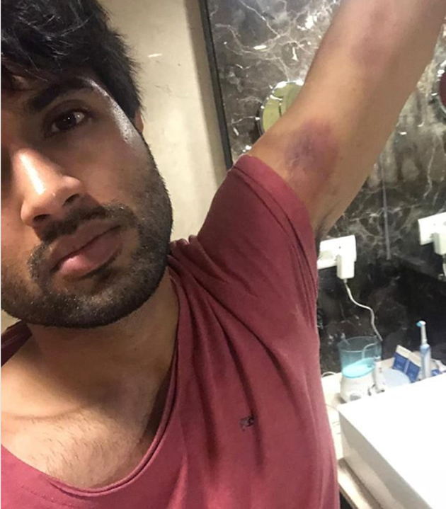 Rowdy Boy Flaunts His Bruises Rowdy Boy Flaunts His Bruises