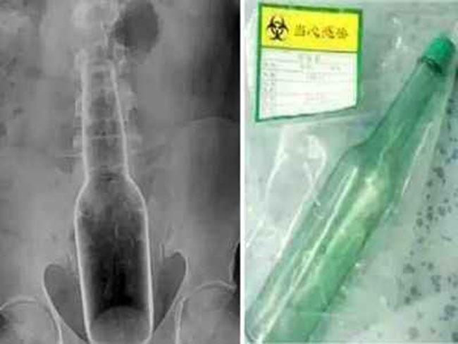 ఎంత దురద పుడితే మాత్రం సీసా పెట్టేసి చిక్కుల్లో పడ్డాడు