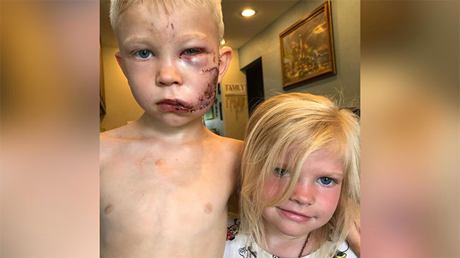 చెల్లి కోసం ఆరేళ్ల అన్న కుక్కతో‌ పోరాటం