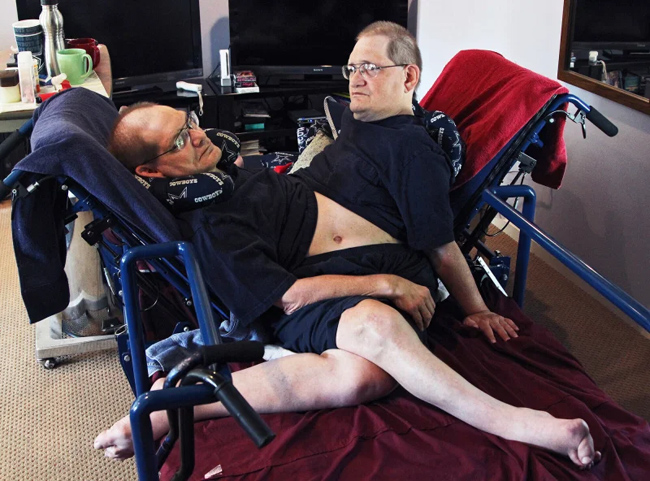 Worlds Oldest Conjoined Twin Brothers Are No More