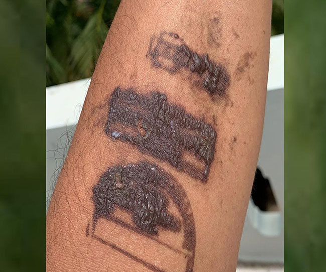 తన చేతి ఫోటోను కేంద్రమంత్రికి ట్వీట్ చేసిన మధు యాష్కీ