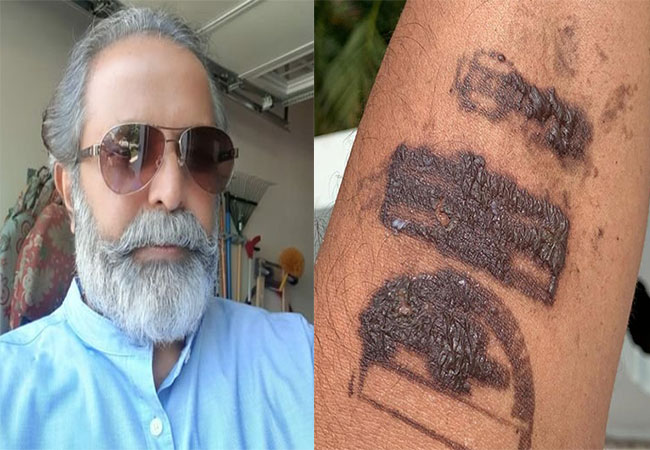 Covid Stamp At Airport Caused Skin Burns To Ex-MP