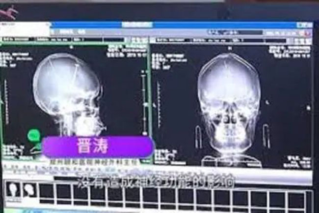 యువతి మెదడులో సూదులు.. సీటీస్కాన్​లో బయటపడ్డ దారుణనిజం