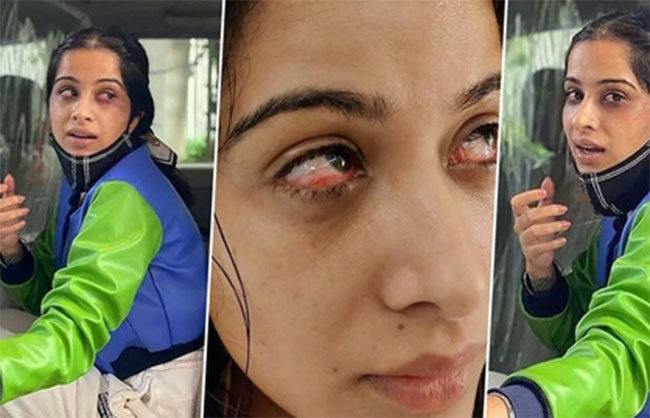 బిగ్‌ బాస్‌ కంటెస్టెంట్‌ కంటికి గాయం