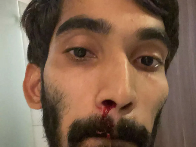 ఆటగాళ్లకు కొవిడ్ తిప్పలు.. ఆ స్టార్ క్రీడాకారుడికి రక్తం కారింది