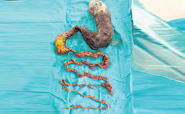 అమ్మాయి కడుపులో 2 కిలోల వెంట్రుకలు.. ఎలా వచ్చాయంటే ?