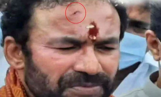 కిషన్ రెడ్డి తలకు ఆ గాయం ఏమిటి? ఎందుకలా జరిగింది?